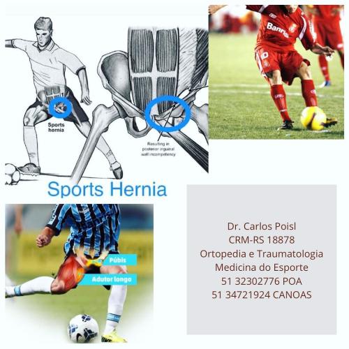 Sports Hernia